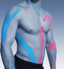 kinesio taping